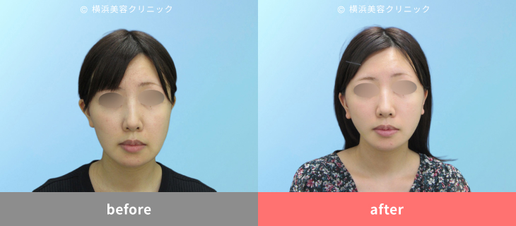 【20代女性】骨切り・脂肪吸引後のたるみをフェイスリフトで改善【横浜美容クリニック】