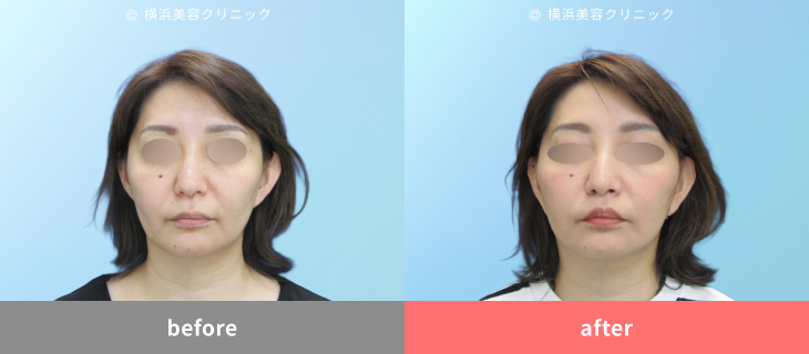 【40代女性】フェイスリフト＋人中短縮術で、より若々しく引き締まった印象に【横浜美容クリニック】