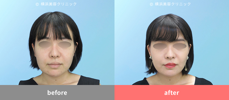 【20代女性】エラの骨切り、脂肪吸引後のたるみをフェイスリフトで改善【横浜美容クリニック】