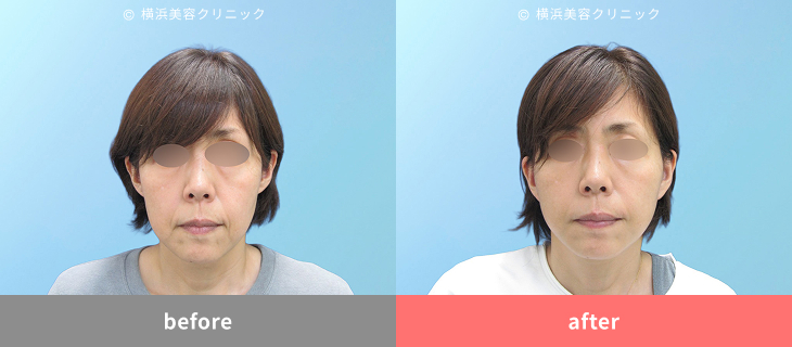 【50代女性】フェイスラインのもたつき解消で横顔もスッキリ【横浜美容クリニック】