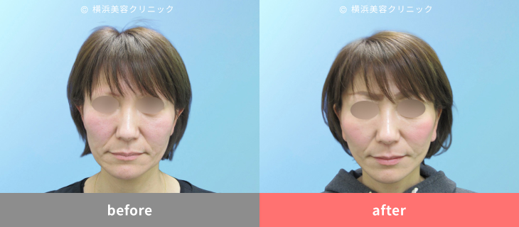 【40代女性】頬の下垂で四角くなった輪郭が、自然な卵型に変化【横浜美容クリニック】