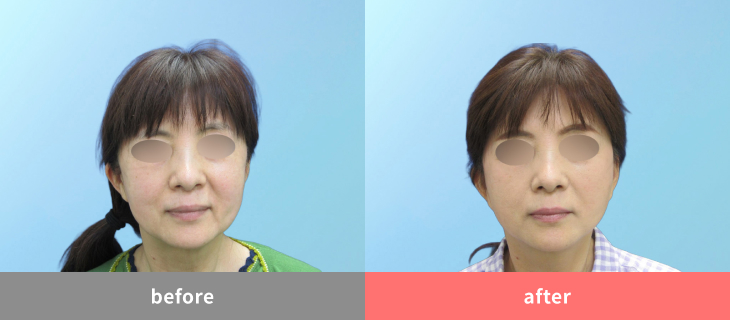 【60代女性】左右差が目立っていたお顔も自然なバランスに【横浜美容クリニック】