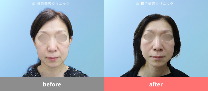 【40代女性】二重あご・フェイスラインの改善にはフェイスリフト（切開リフト）が効果的【横浜美容クリニック】