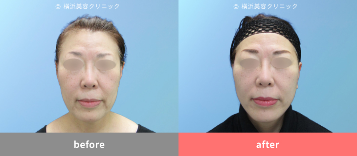 【60代女性】頬のたるみとマリオネットラインにアプローチ　フェイスリフトで自然な若返り【横浜美容クリニック】