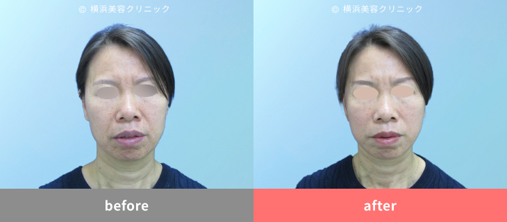 【50代女性】二重あごの改善にフェイスリフトが有効　横顔でわかるフェイスラインの変化【横浜美容クリニック】