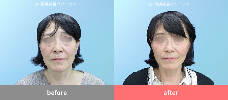 【60代女性】繊細な肌質に合わせたリフトアップで、自然な若返りを実現【横浜美容クリニック】