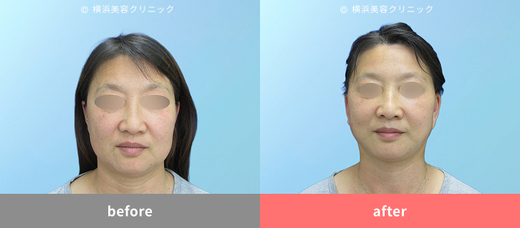 【50代女性】エラ張り×たるみで強調された輪郭をシャープに改善【横浜美容クリニック】