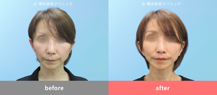 【50代女性】面長印象を解消!卵型フェイスで若々しい印象に【横浜美容クリニック】