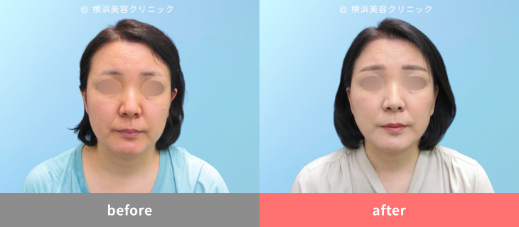 【50代女性】フェイスリフト+脂肪吸引で輪郭スッキリ【横浜美容クリニック】