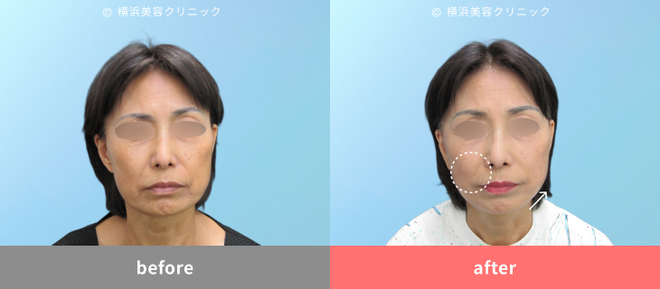 【60代女性】再手術で再び若々しく！フェイスリフト＋耳たぶ修正【横浜美容クリニック】